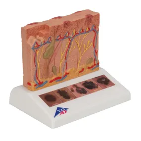 Skin Cancer Model